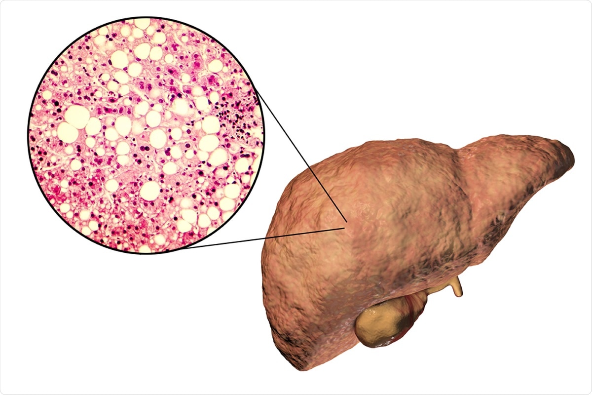 Fatty liver, liver steatosis, 3D illustration and photomicrograph showing large vacuoles of triglyceride fat accumulated inside liver cells, it occurs in alcohol overuse, under action of toxins. Image Credit: Kateryna Kon / Shutterstock