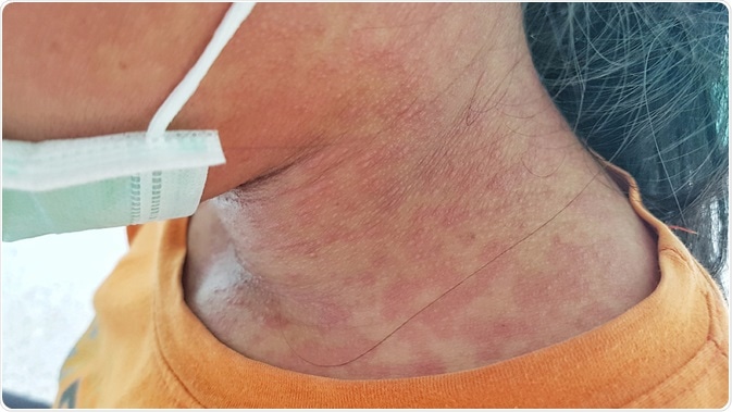 Skin of rubella patient. Image Credit: Akkalak Aiempradit / Shutterstock