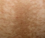 Acanthosis Nigricans Skin Condition