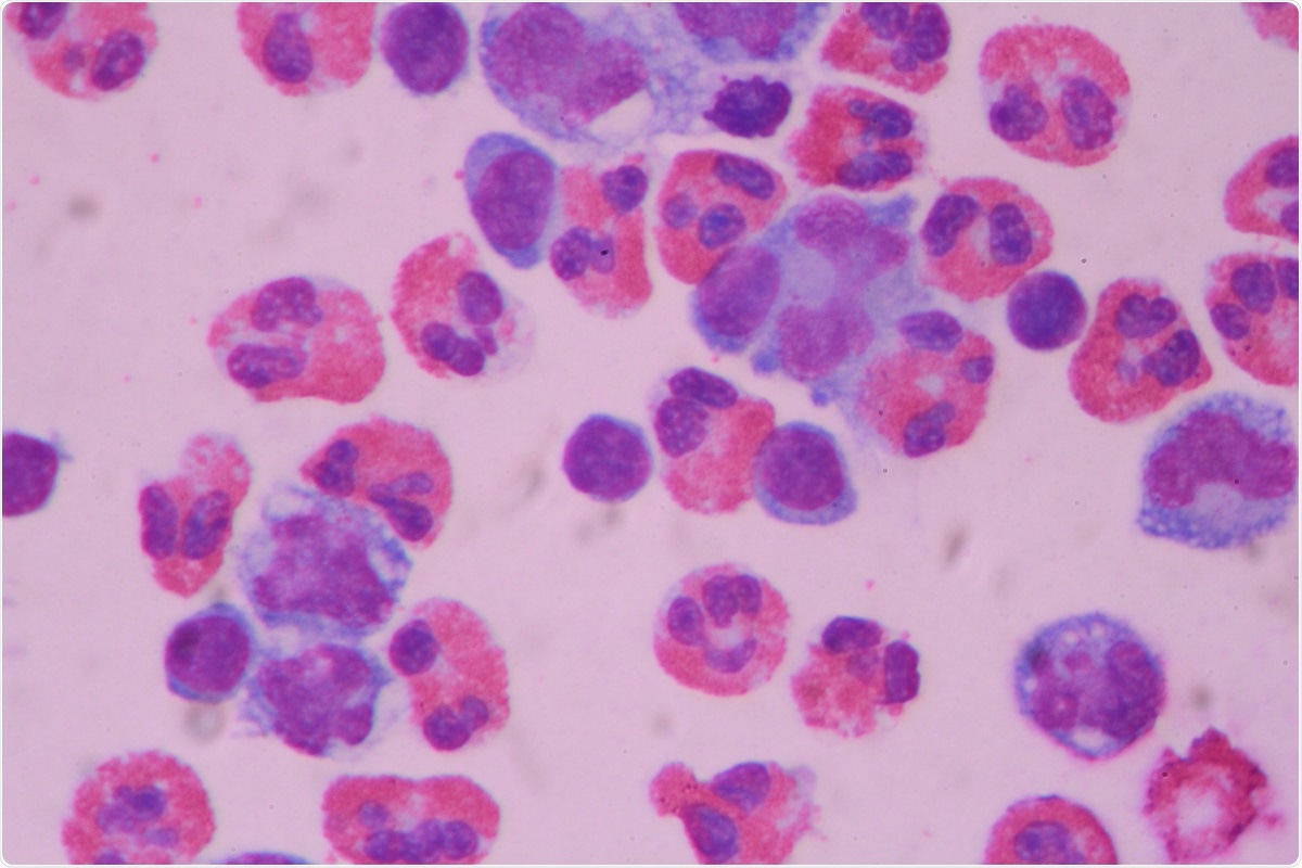 Timeline of clinical features in patients with COVID-19 with neurological complications. Temporal profile of COVID-19 and neurological symptoms as related with the time of CSF analysis (vertical blue line) for the 18 subjects included in the study. Patients were classified based on the NIH disease severity classification (56). Eight subjects presented with neurological symptoms as the first manifestation of COVID-19 (light pink bar), eight exhibited systemic illness symptoms preceding neurological symptoms (dark pink bar) and two presented with mixed neurological and systemic symptoms (diagonal stripes).