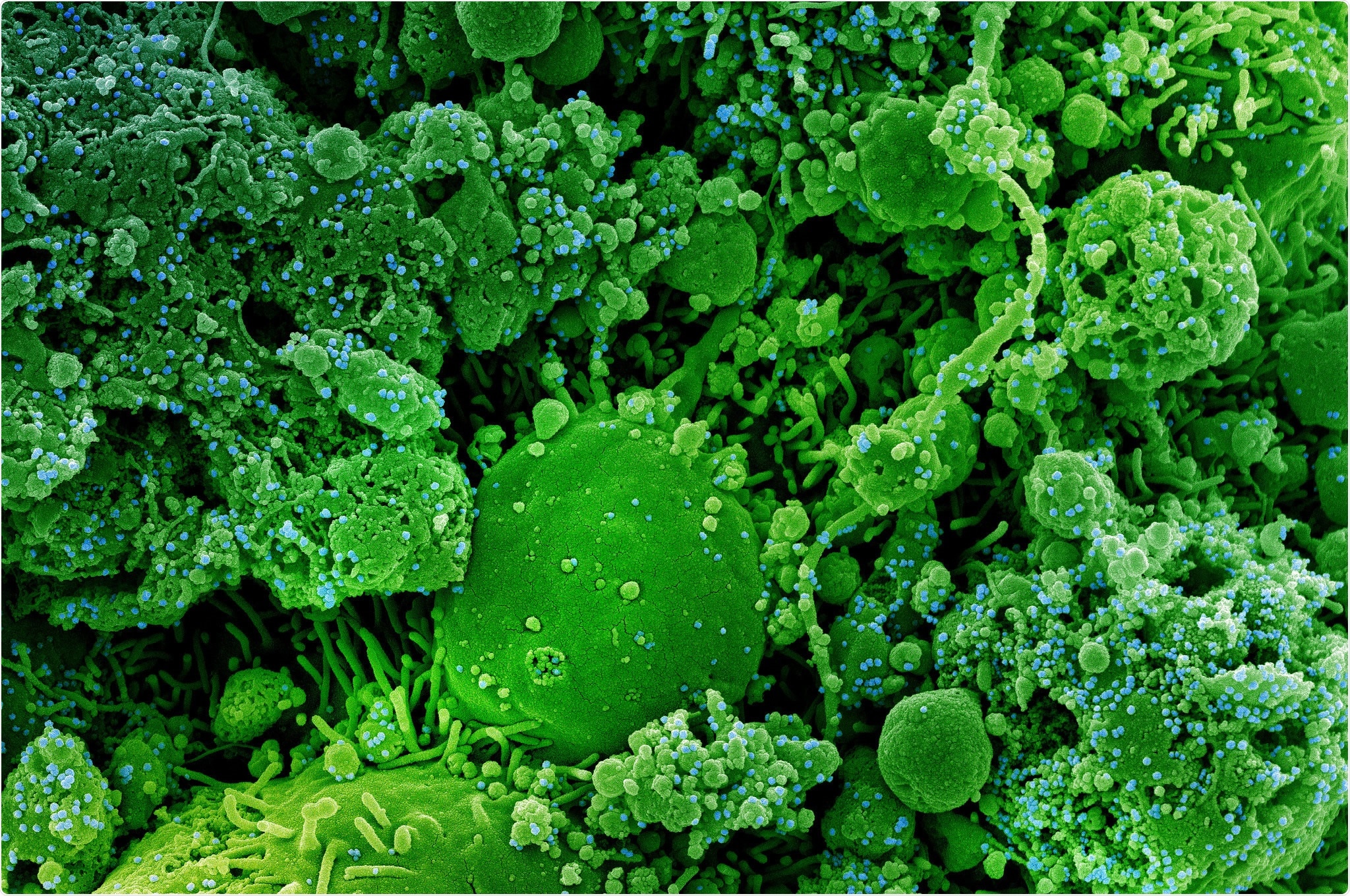 Study: Impaired Neutralizing Antibody Response to COVID-19 mRNA Vaccines in Cancer Patients. Image Credit: NIAID