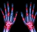 New evidence-based points to consider and consensus definitions for people with psoriatic arthritis