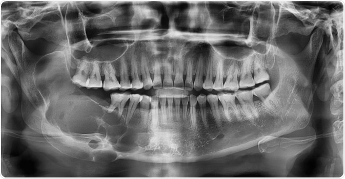 Ameloblastoma