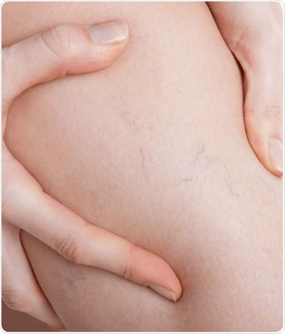 What are thread veins?