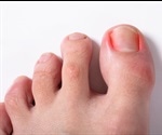 Ingrown Toenail Causes