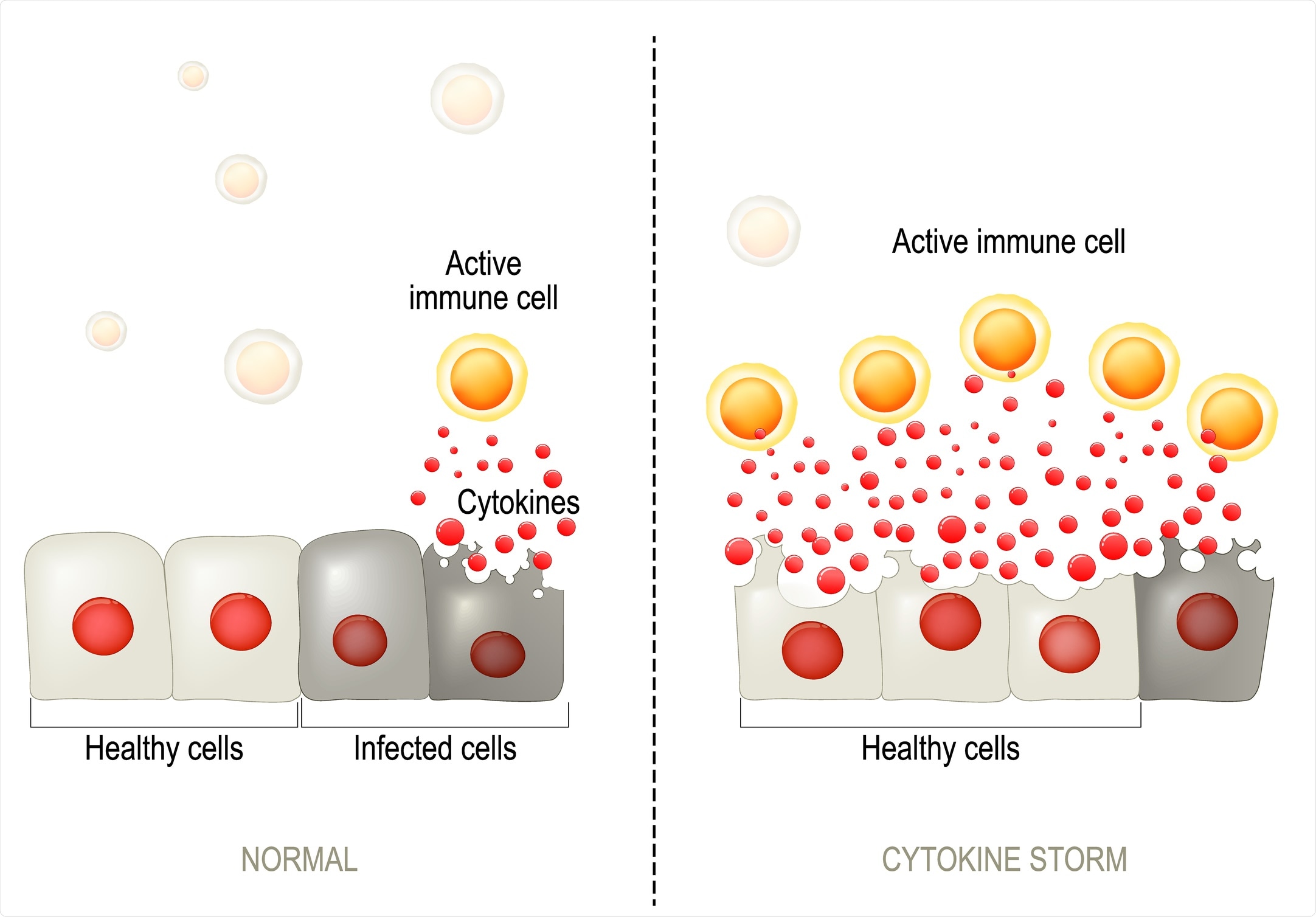 Study: Activin A correlates with the worst outcomes in COVID-19 patients, and can be induced by cytokines via the IKK/NF-kappa B pathway. Image Credit: Optimarc / Shutterstock