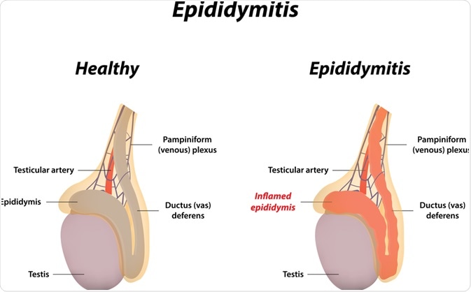 Epididymitis. Image Credit: joshya / Shutterstock