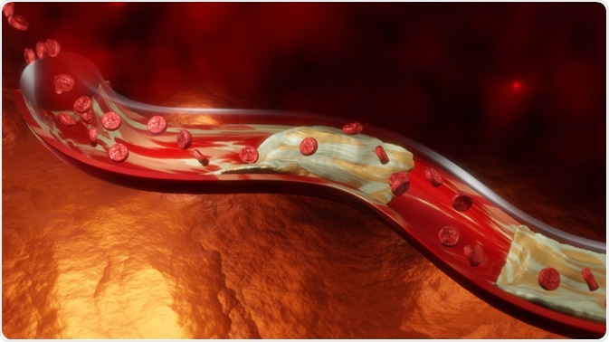 peripheral arterial disease