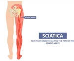 What is Sciatica?
