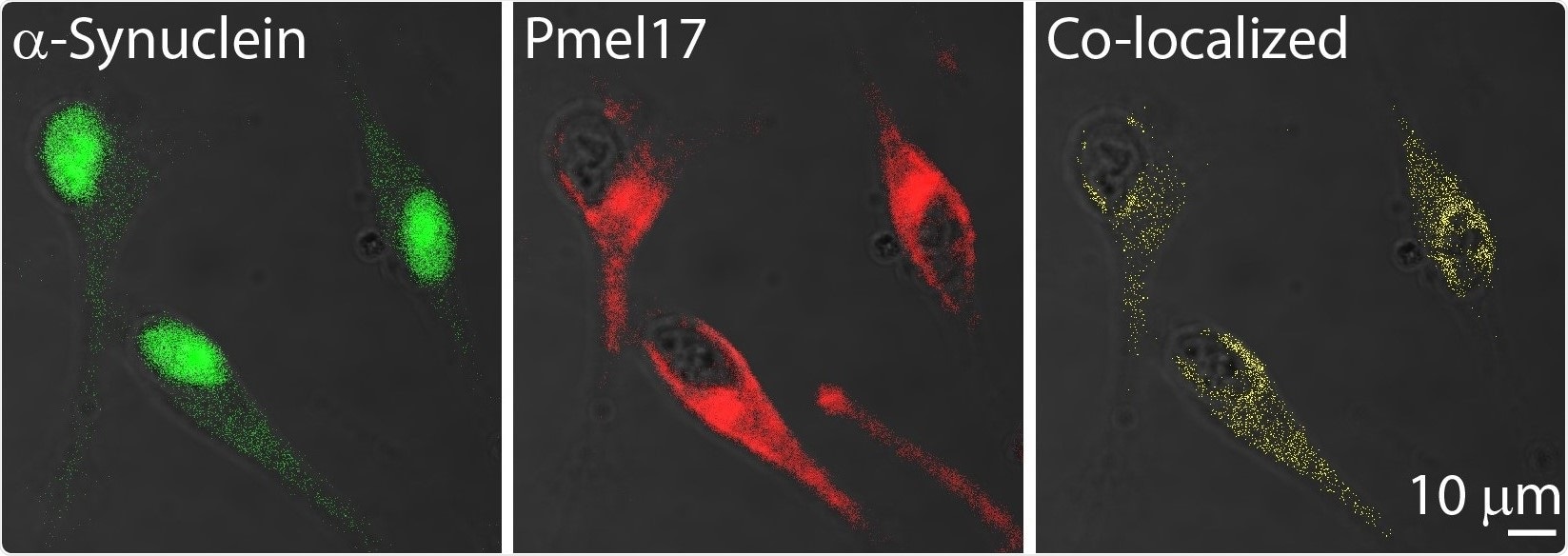 Study indicates an amyloid link between melanoma and Parkinson’s disease
