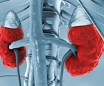 Living with Chronic Kidney Disease