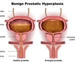 Symptoms of Benign Prostatic Hyperplasia (BHP)