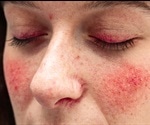 Rosacea Prevention