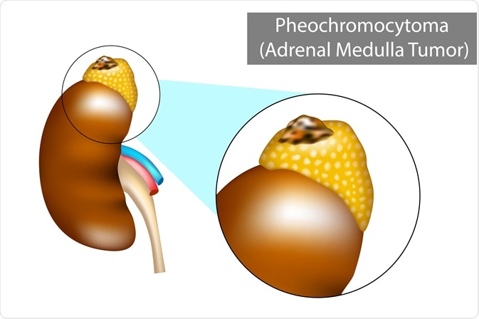 pheochromocytoma
