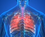 What is Idiopathic Pulmonary Fibrosis?