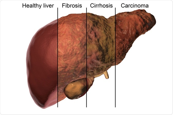 liver cirrhosis