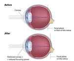 LASIK History