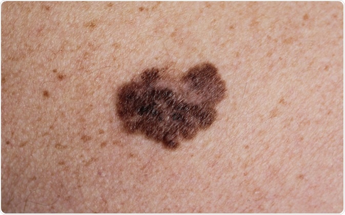 melanoma