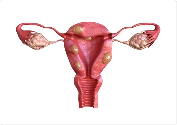 uterine fibroids
