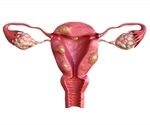 Uterine Fibroids Malignancy