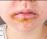 What is Impetigo?