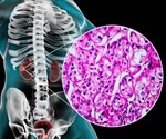 Renal Cell Carcinoma Symptoms