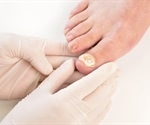 Onychomycosis Diagnosis