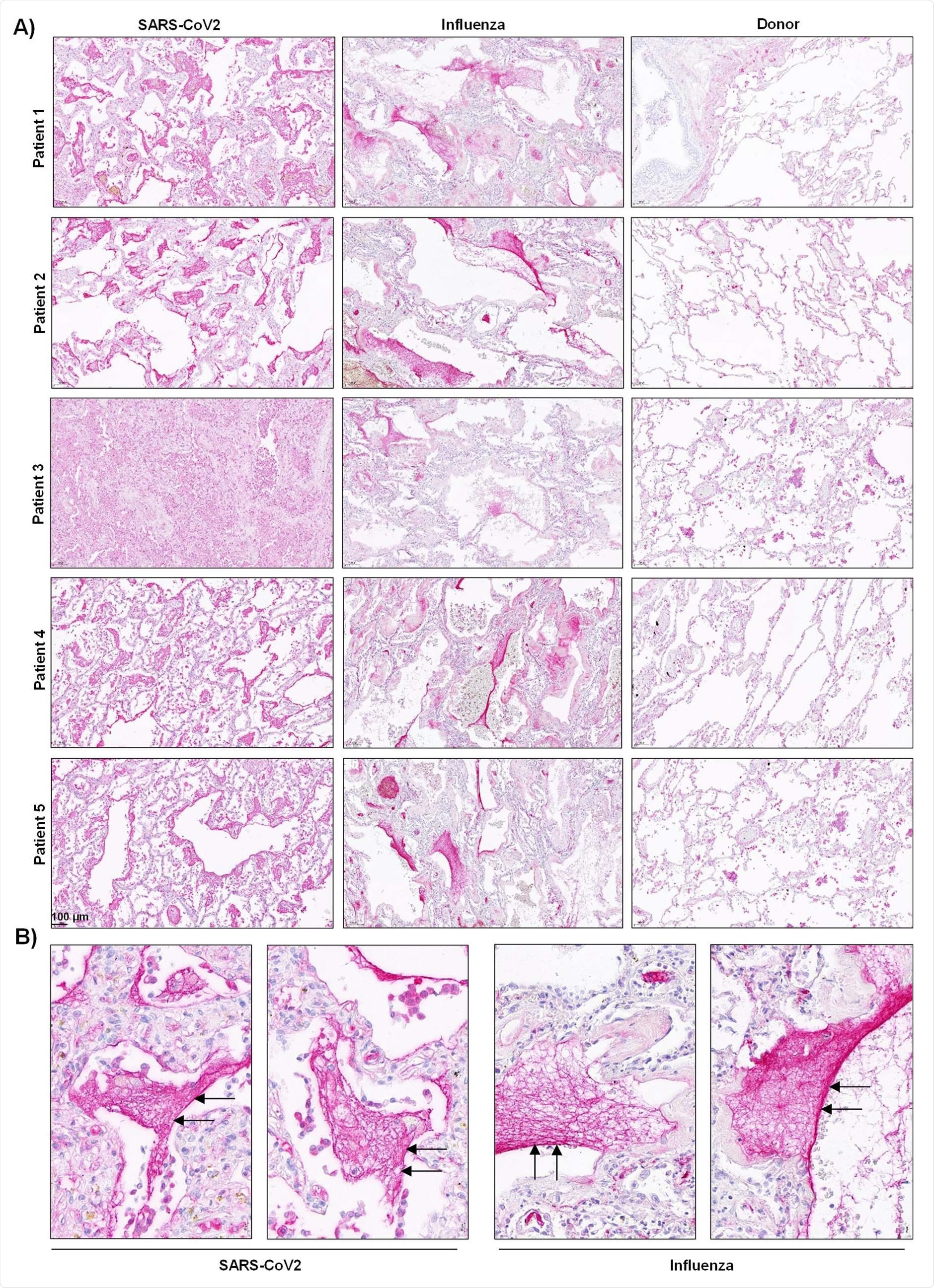 Activation of the contact phase system in plasma of critically ill COVID-19 patients. A,C) Western blot analysis (left panels) of factor XII (FXII) A) and high molecular weight kininogen (HK) C) in plasma from moderate and severe COVID-19 patients (infected with SARS-CoV2) and donors. Four out of 15 moderate and severe COVID-19 patients and 3 out of 15 donors are demonstrated. Rights panels show the specificity of the antibodies used. B, D) Densitometric analysis of A) and C), respectively. COVID-19 moderate/severe