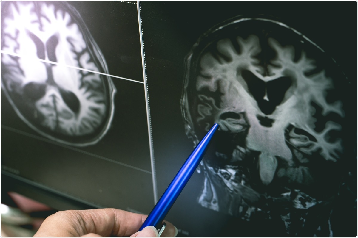 Study: Can SARS-CoV-2 Infection Exacerbate Alzheimer’s Disease? An Overview of Shared Risk Factors and Pathogenetic Mechanisms. Image Credit: Atthapon Raksthaput / Shutterstock.com