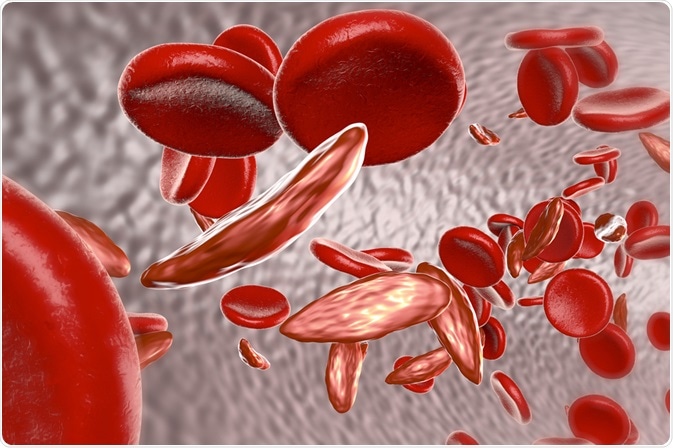 sickle cell