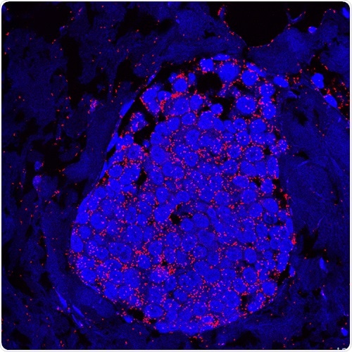 Study provides key information about the mechanism of breast cancer progression Study provides key information about the mechanism of breast cancer progression