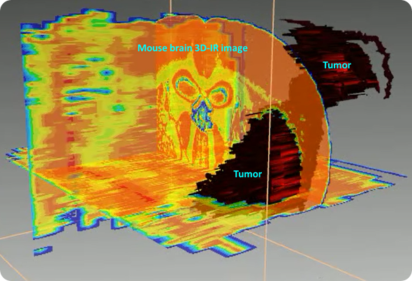 3D reconstruction of the tumor based on lipid/protein ratio. The tumor is presenting higher amount of proteins while brain is a “fatty” organ, thus making this ratio significantly different between tumor and healthy brain tissues.