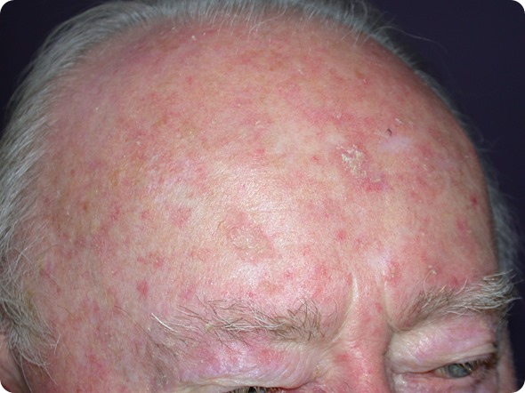 Actinic keratosis on the scalp of a male