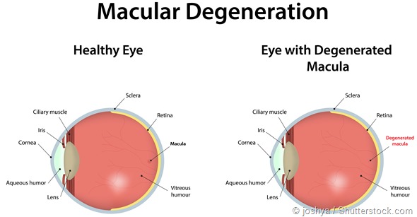 Age Related Macular Degeneration