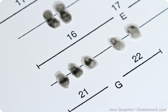 Chromosome 21 Down syndrome