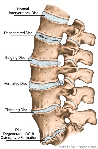 Disc problems spine