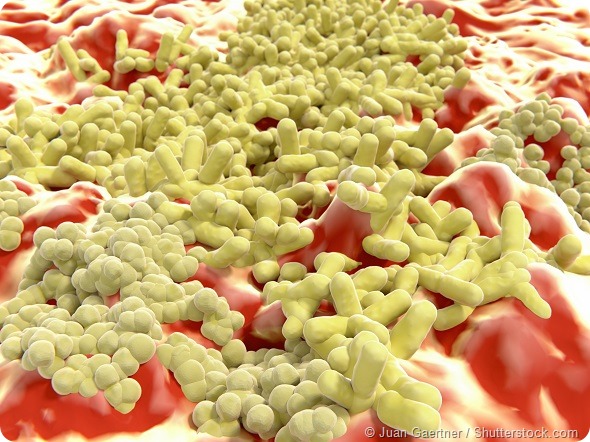 Multiresistant bacteria, MRSA