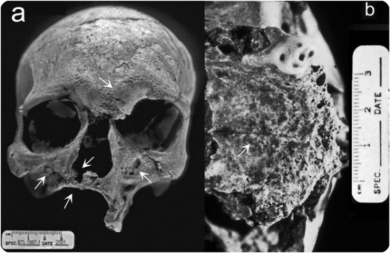 A) Anterior view demonstrates bilateral erosive lesions at the supraorbital region and glabella, erosion/remodeling of the margin of the nasal aperture, including the anterior nasal spine, bilateral necrosis of the infraorbital region of the maxilla, and resorption of the alveolar region of the maxilla with associated antemortem tooth loss. B) Inferior view of the maxilla demonstrates pathological changes to the palatine process including pitting near the midline and in the alveolar region.