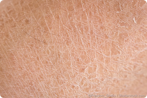 dry skin
