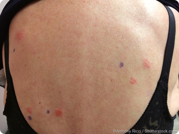 positive skin patch test