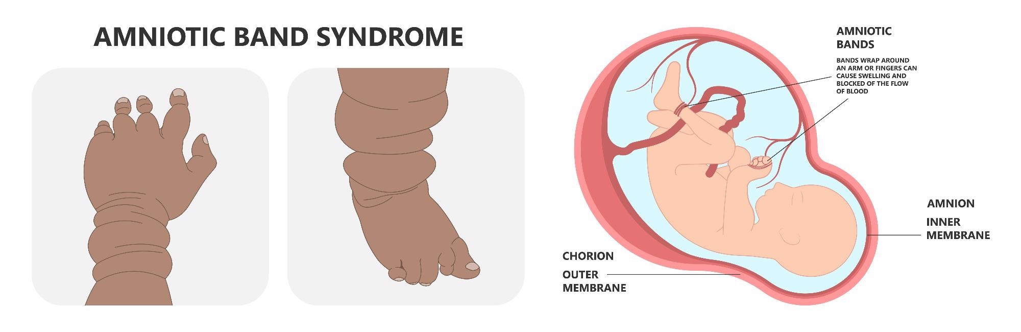 Amniotic band syndrome