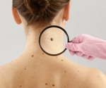 What are the Statistics of Melanoma?