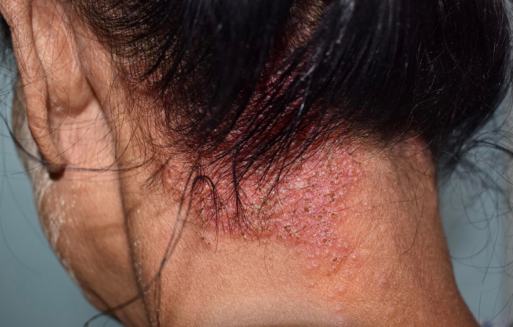 Seborrheic dermatitis. Image Credit: Zay Nyi Nyi / Shutterstock