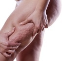 What Causes Cellulite?