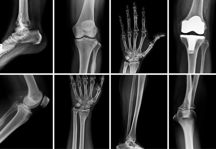 Raman spectroscopy for cancer detection