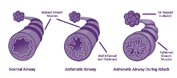 How to manage asthma in children