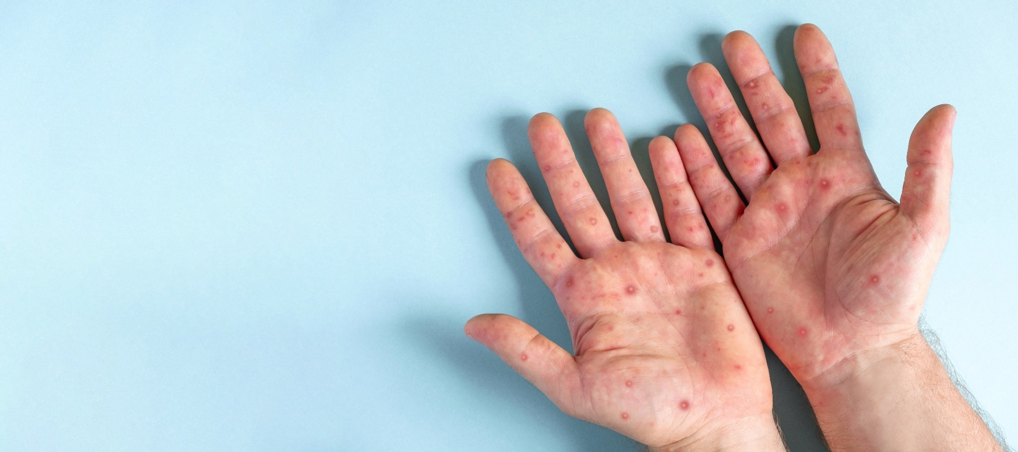 Infection control strategies to address the mpox outbreak