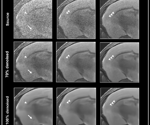 Improving noise reduction methods in structural MRI imaging