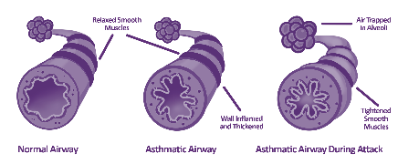 Addressing inequality in asthma treatment and diagnosis