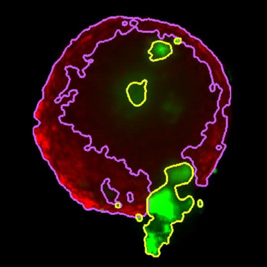 Z slice of the tumor microtissue treated with 5 μM Lapatinib - tumor (yellow region) is decreased significantly comparing to the one treated with 0.005% DMSO